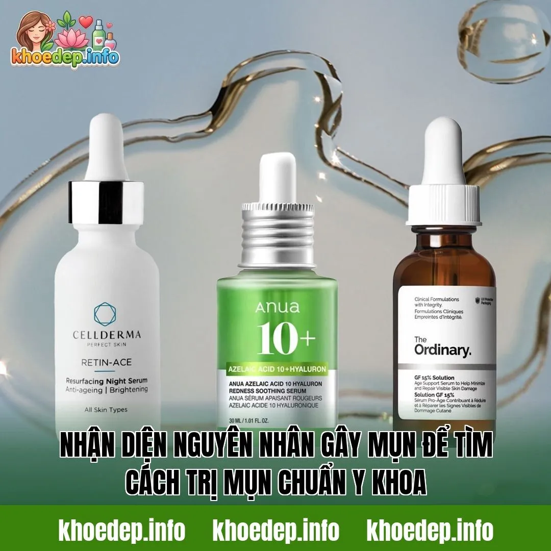 Nhận diện nguyên nhân gây mụn để tìm cách trị mụn chuẩn y khoa